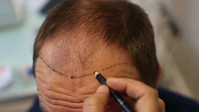 Photo of وفاة شخص في عملية زراعة شعر تحير الأطباء