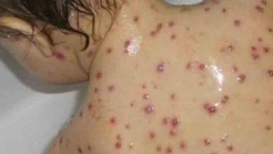 Photo of مرضى “بوحمرون”..جهة شمال المملكة تسجل حالتي وفاة و441 إصابة جديدة