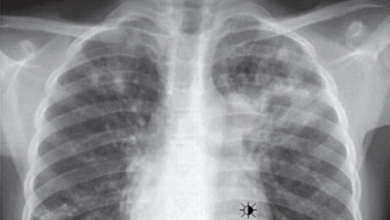Photo of تحول مقلق في انتشار السل بالمغرب: أكثر من نصف الحالات خارج الرئتين